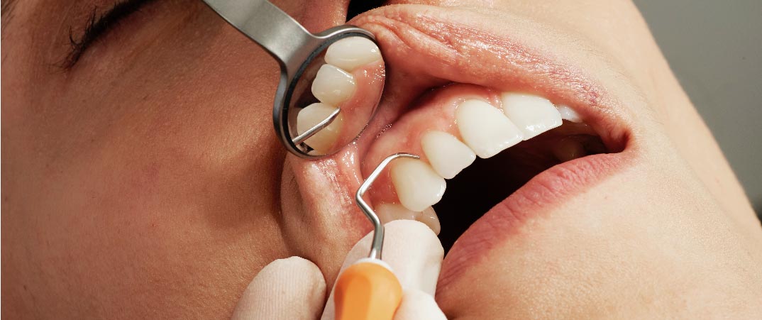 使用手動牙科器械，如牙科鏡、探針和手動刮板等，以手動方式清除牙齒表面和牙齒周圍的牙菌斑和牙石